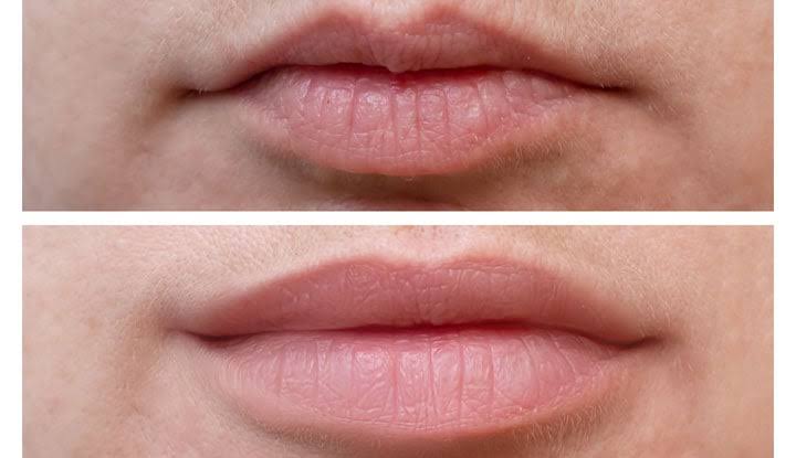 Botox and lip fillers